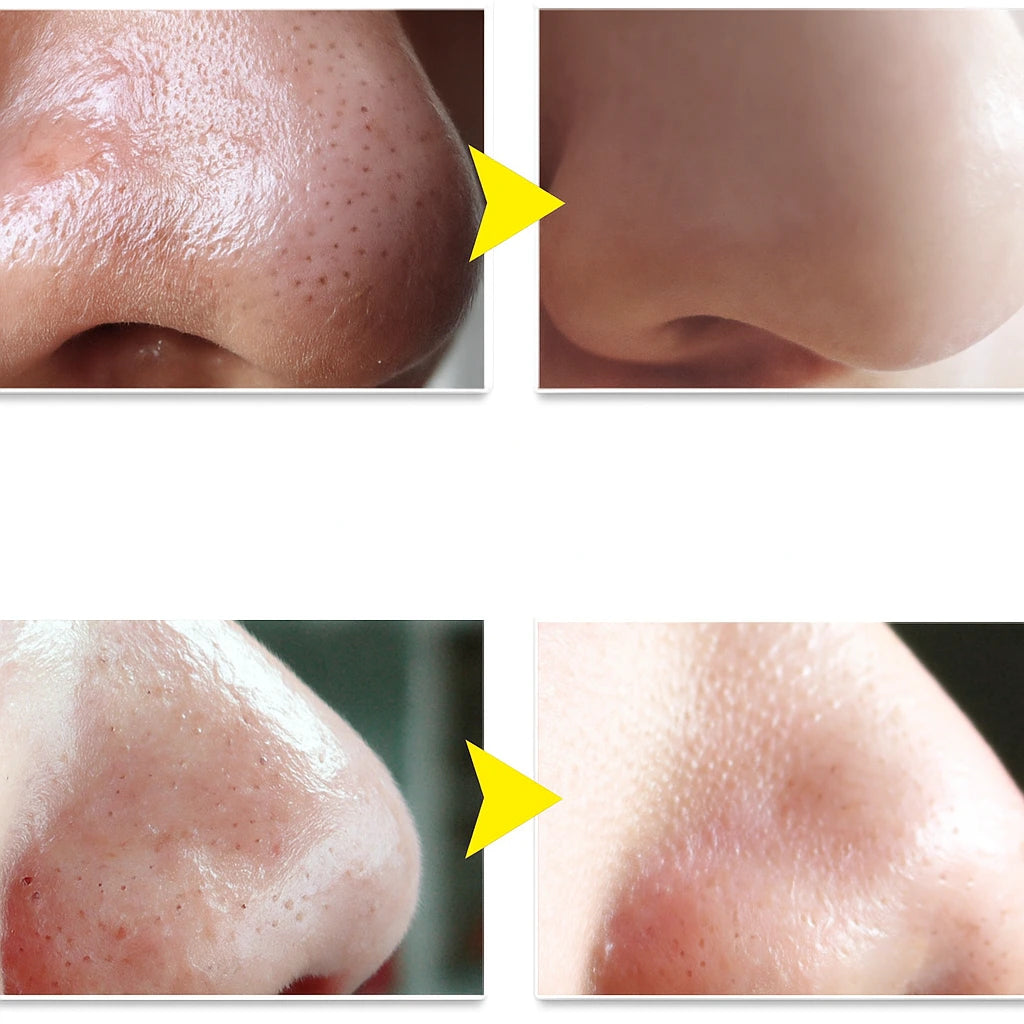 BlackOut Lanbena | Blackhead Removal Cream + Strips (60 pcs) - Aveneli