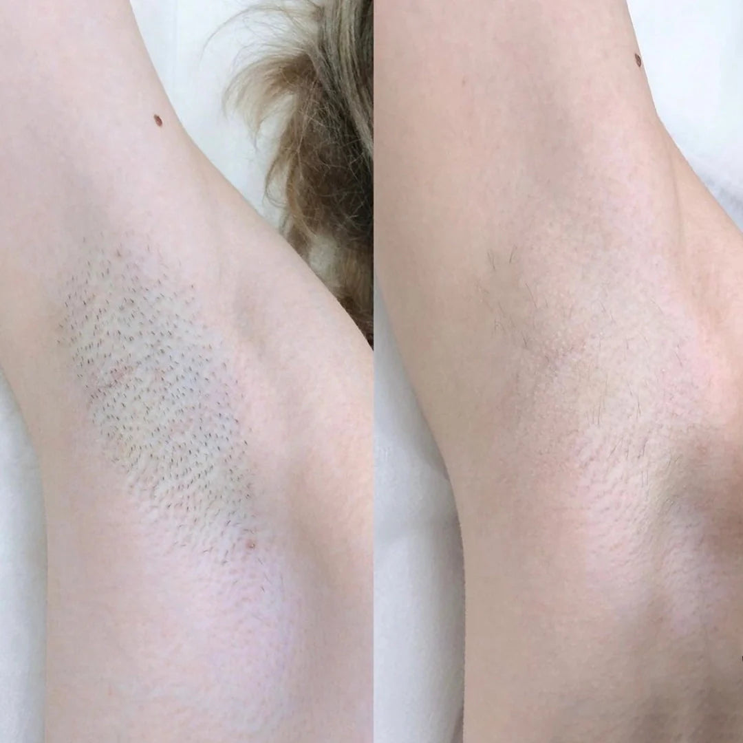 SilkTrim™ – 2-in-1 Painless Body Hair Trimmer - Aveneli